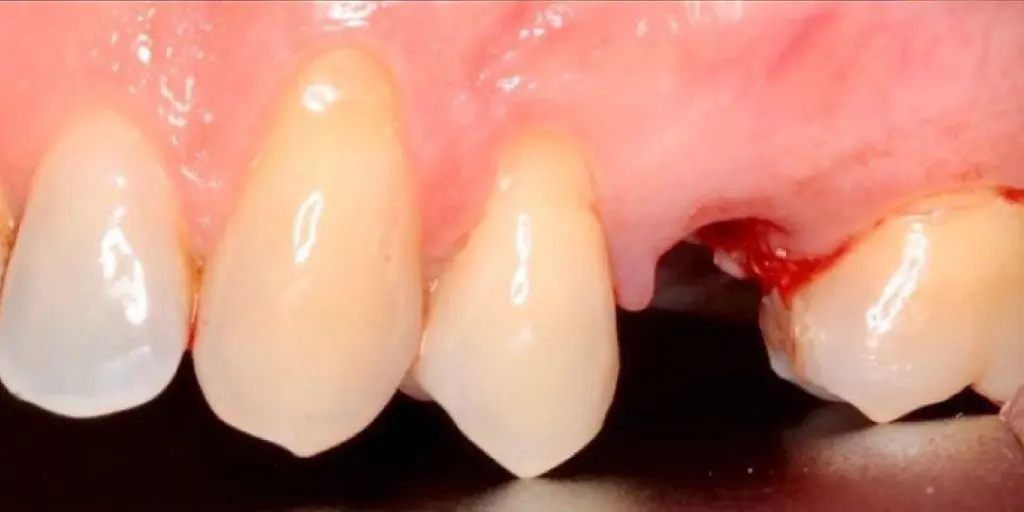 Realización de Implante dental de carga inmediata en Clínica Mozas
