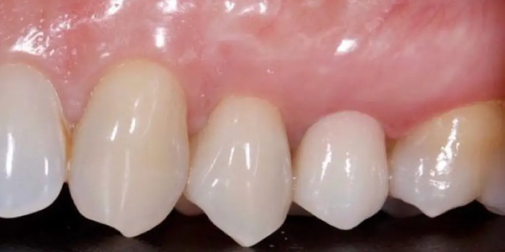 Resultado de Implante dental de carga inmediata