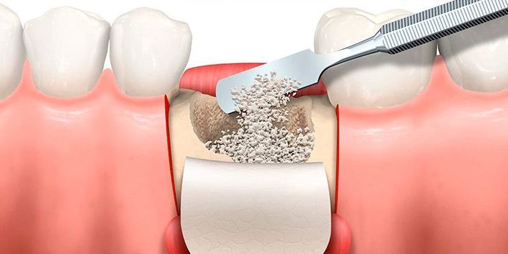 injerto-hueso-regeneracion-osea-1