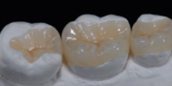 restauraciones-indirectas-clinica-dental-mozas-vitoria-gasteiz