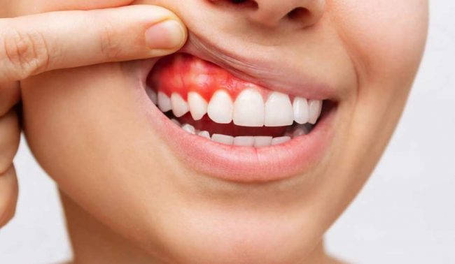 Qué es la periodontitis