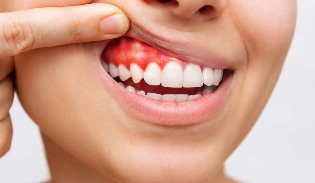 Qué es la periodontitis