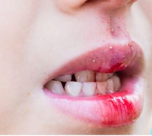 Qué hacer si mi hijo se da un golpe en un diente