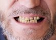 Dientes desgastados