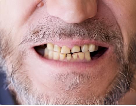 Dientes desgastados
