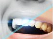 Preguntas más frecuentes acerca del blanqueamiento dental