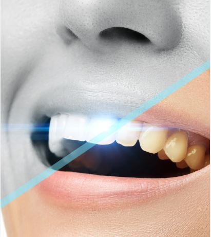 Preguntas más frecuentes acerca del blanqueamiento dental