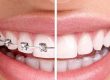 Ventajas y desventajas de la ortodoncia invisible vs brackets