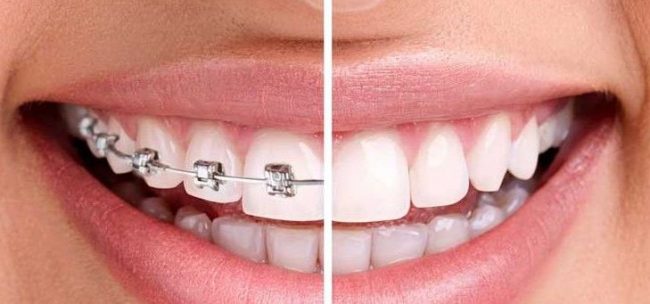 Ventajas y desventajas de la ortodoncia invisible vs brackets
