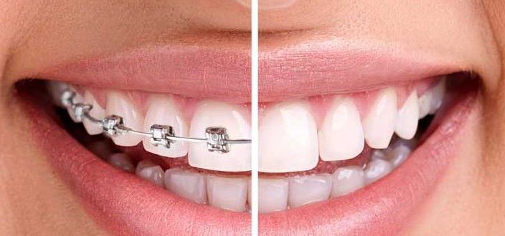 Ventajas y desventajas de la ortodoncia invisible vs brackets