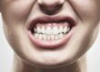 Férula dental para el bruxismo