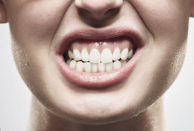 Férula dental para el bruxismo