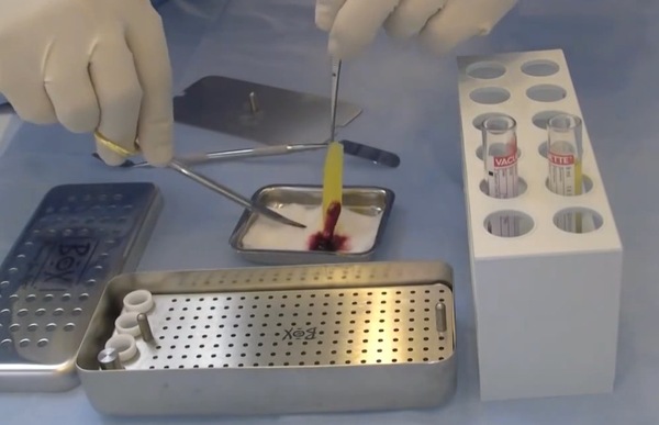 PRF en Clínica Dental Mozas - Dentistas en Vitoria