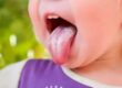 Candidiasis oral: Qué es y cómo prevenirla