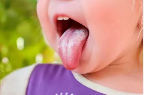 Candidiasis oral: Qué es y cómo prevenirla