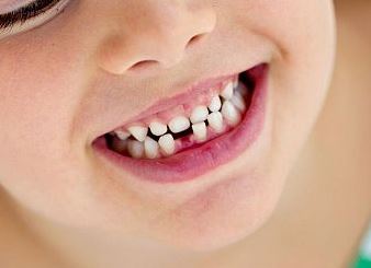 Problemas dentales en niños