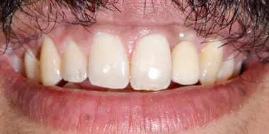 resultado implante dental diente faltante