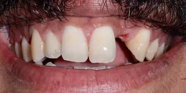 implante dental sin diente