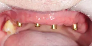 Implante dental sobredent