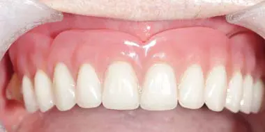 resultado implante dental sobredent