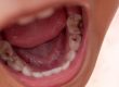 caries en niños