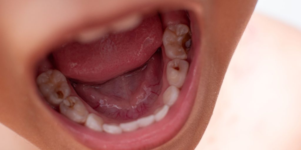 caries en niños
