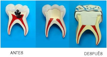 tratamiento pulpar dental
