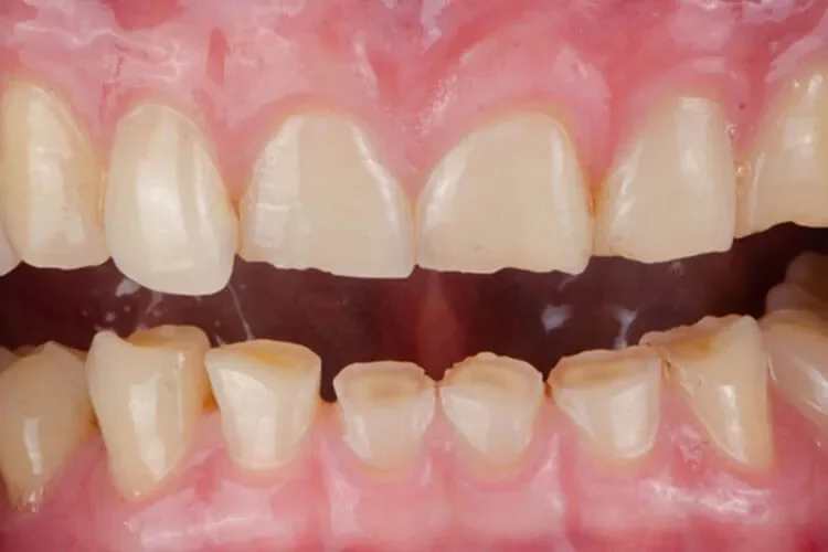 desgaste dental
