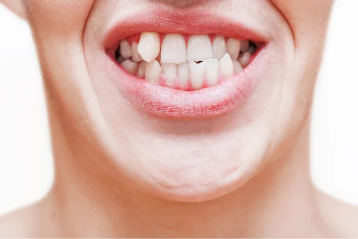 dientes apiñados