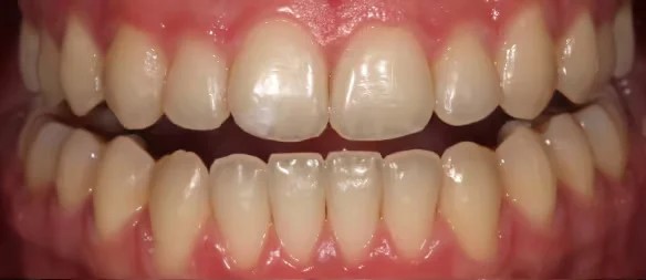 dientes oscuros