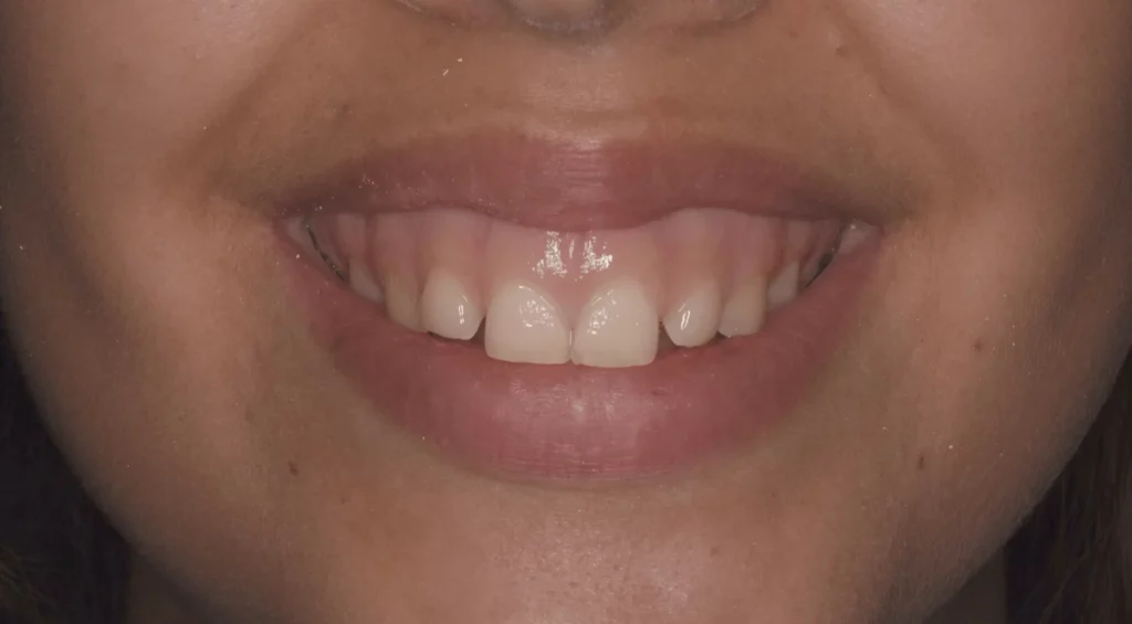 sonrisa gingival