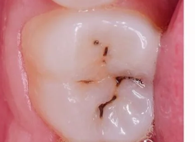 Detectar caries sin dolor