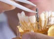 duración implantes dentales