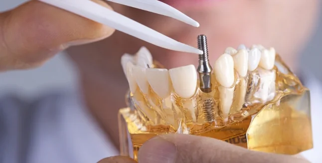 duración implantes dentales